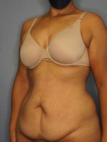 Abdominoplasty Before & After Patient #3322