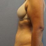Abdominoplasty Before & After Patient #3322