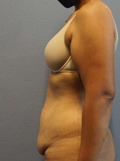 Abdominoplasty Before & After Patient #3322