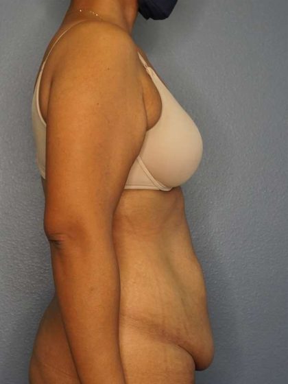 Abdominoplasty Before & After Patient #3322