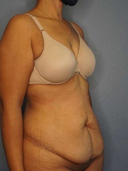 Abdominoplasty Before & After Patient #3322