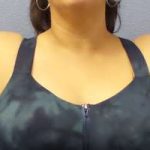 Liposuction Female Before & After Patient #7726