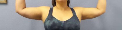 Liposuction Female Before & After Patient #7726