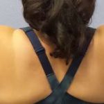 Liposuction Female Before & After Patient #7726