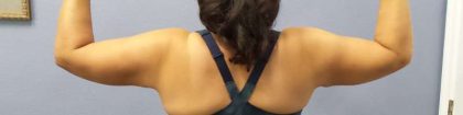 Liposuction Female Before & After Patient #7726