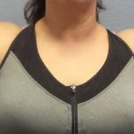 Liposuction Female Before & After Patient #7726