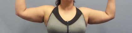 Liposuction Female Before & After Patient #7726