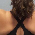 Liposuction Female Before & After Patient #7726