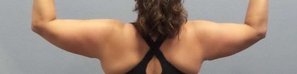Liposuction Female Before & After Patient #7726
