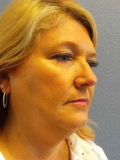 Liposuction of the Neck Before & After Patient #8275