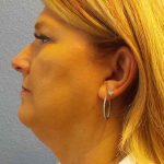 Liposuction of the Neck Before & After Patient #8275