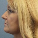 Liposuction of the Neck Before & After Patient #8275