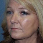 Liposuction of the Neck Before & After Patient #8275