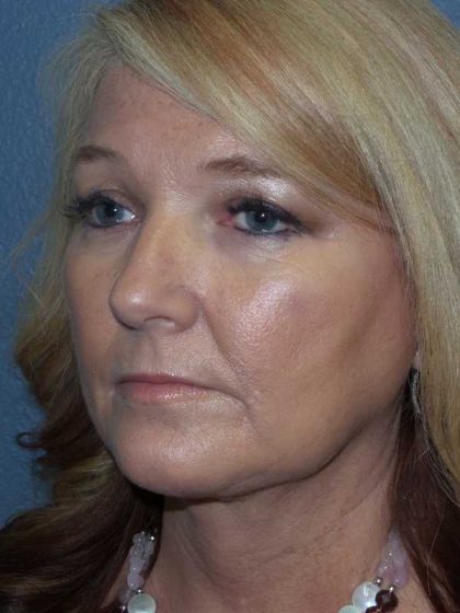 Liposuction of the Neck Before & After Patient #8275
