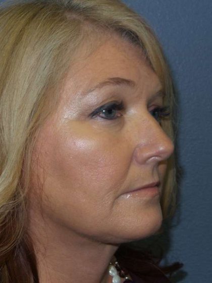 Liposuction of the Neck Before & After Patient #8275