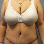 Abdominoplasty Before & After Patient #3520
