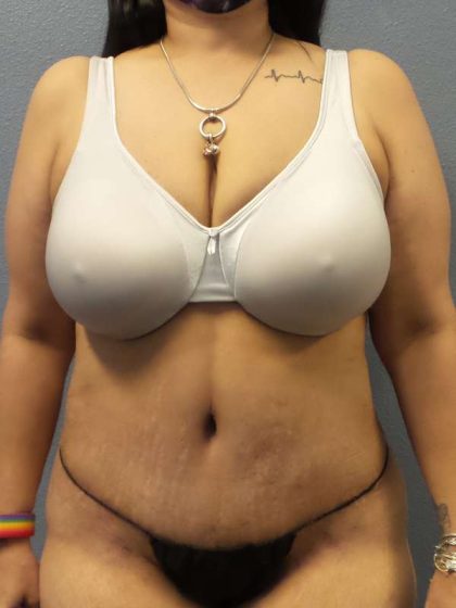 Abdominoplasty Before & After Patient #3520