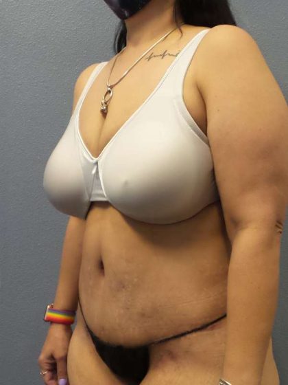 Abdominoplasty Before & After Patient #3520
