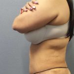 Abdominoplasty Before & After Patient #3520