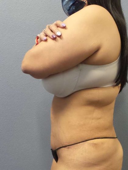 Abdominoplasty Before & After Patient #3520