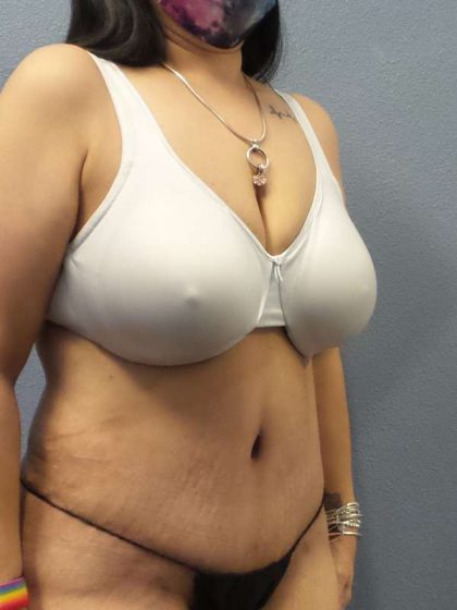 Abdominoplasty Before & After Patient #3520