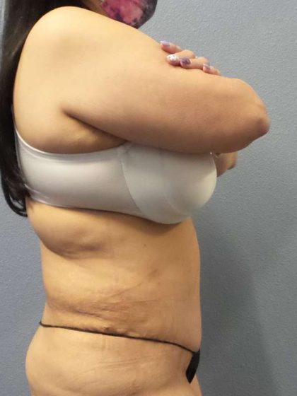 Abdominoplasty Before & After Patient #3520