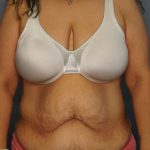 Abdominoplasty Before & After Patient #3520