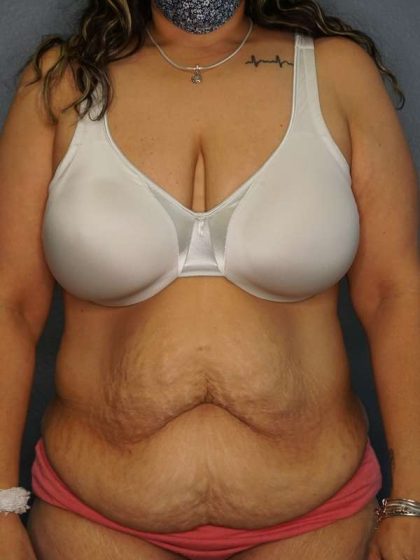 Abdominoplasty Before & After Patient #3520