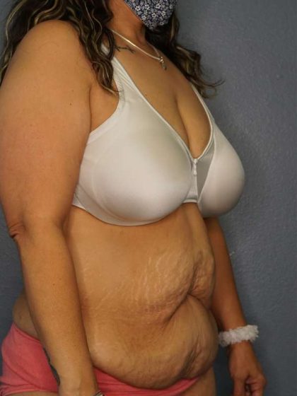 Abdominoplasty Before & After Patient #3520