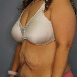 Abdominoplasty Before & After Patient #3520