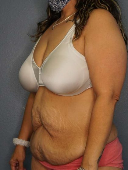 Abdominoplasty Before & After Patient #3520