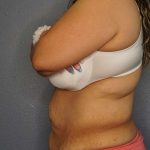 Abdominoplasty Before & After Patient #3520