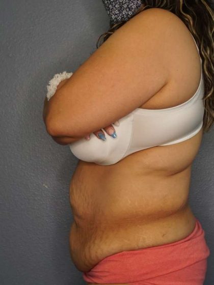Abdominoplasty Before & After Patient #3520