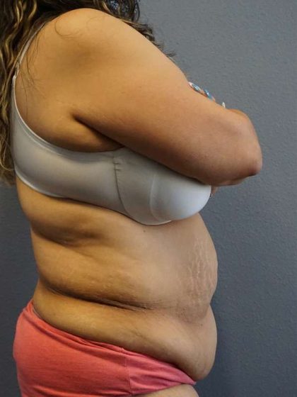 Abdominoplasty Before & After Patient #3520