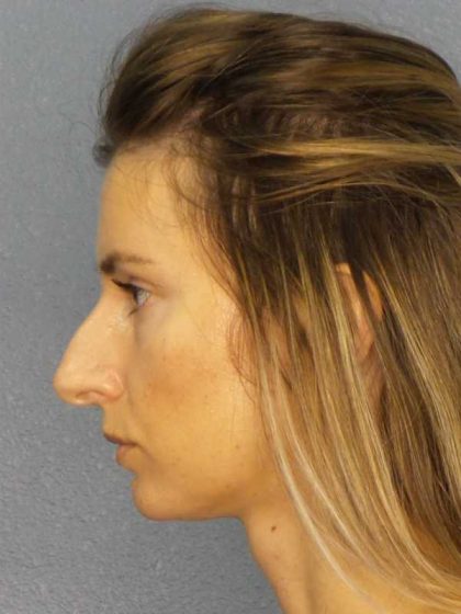 Rhinoplasty Before & After Patient #10792