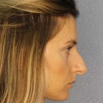 Rhinoplasty Before & After Patient #10792