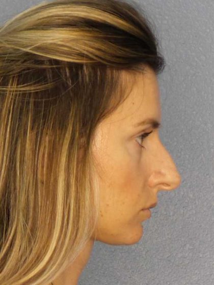 Rhinoplasty Before & After Patient #10792