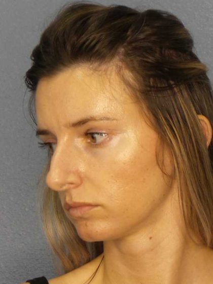 Rhinoplasty Before & After Patient #10792