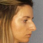 Rhinoplasty Before & After Patient #10792