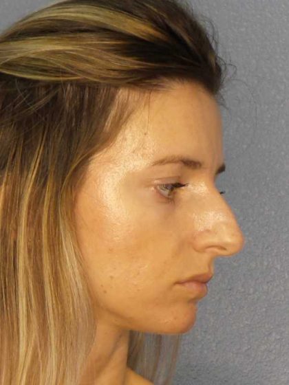 Rhinoplasty Before & After Patient #10792