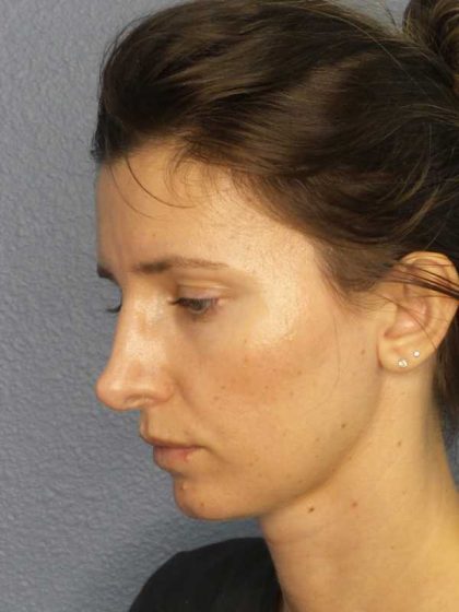 Rhinoplasty Before & After Patient #10792