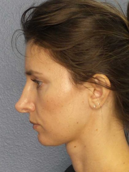 Rhinoplasty Before & After Patient #10792