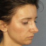 Rhinoplasty Before & After Patient #10792