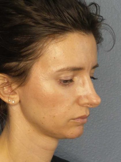 Rhinoplasty Before & After Patient #10792