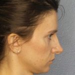 Rhinoplasty Before & After Patient #10792