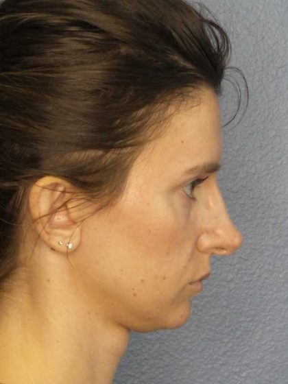 Rhinoplasty Before & After Patient #10792