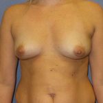 Breast Augmentation Before & After Patient #5542