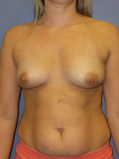 Breast Augmentation Before & After Patient #5542