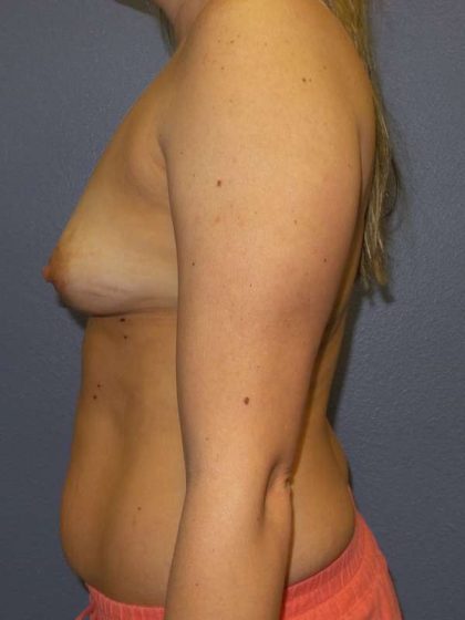 Breast Augmentation Before & After Patient #5542