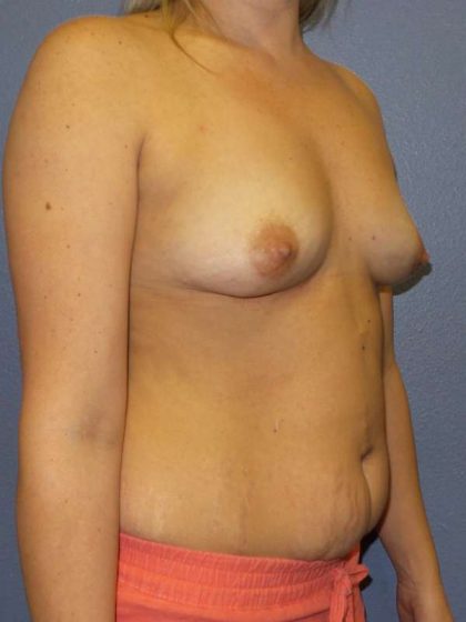 Breast Augmentation Before & After Patient #5542